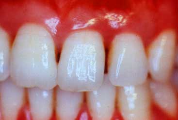 gum disease periodontitis